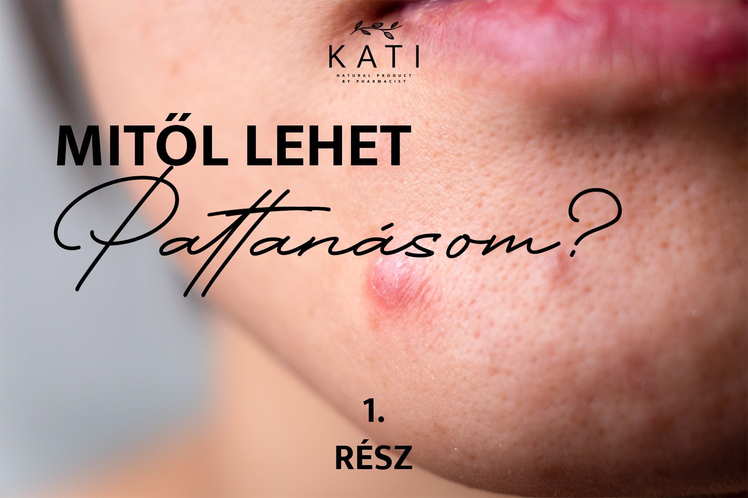 Mitől lehet pattanásom? 1. Rész